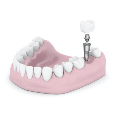 Diagram of dental implant in Charlestown NSW